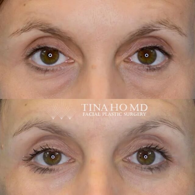 Lower Eyelid Surgery: Before and After
Thuy-Van Tina Ho, MD

This wonderful female patient came to me originally for filler consultation, bothered by her lower eyelid bags. I reviewed with her based on his anatomy that he would benefit best from surgery over non-surgical procedure options. The patient underwent lower blepharoplasty with facial fat transfer and CO2 laser resurfacing and has healed beautifully. We are so thrilled with her beautiful, natural results. 

Empowering patients with beautiful, natural results.
Call or visit my website to schedule your eyelid surgery consultation.

Thuy-Van Tina Ho, MD
Philadelphia’s Female Facial Plastic Surgeon
Double Board-Certified
Facial & Jawline Contouring Expert
www.drtinaho.com | @drtinaho
Wayne @phillyfacialplastics 610.688.3363
Philadelphia @centercityderm 267.687.4437

#philadelphiaplasticsurgery #philadelphia #facialplasticsurgeon #facialplasticsurgery #femaleplasticsurgeon #drtinaho #femalesurgeon #womenempoweringwomen #phillybotox #phillybeauty #bestofphilly #mainlinepa #mainlinemoms #waynepa #phillyfacialplastics

#phillystyle #transformationthursday #beforeandafter #instabeauty #eyelidlift #eyelidsurgery #blepharoplasty #eyelids #facialrejuvenation #lowerblepharoplasty #fattransfer #co2laser #undereyebags #darkcircles #eyelids