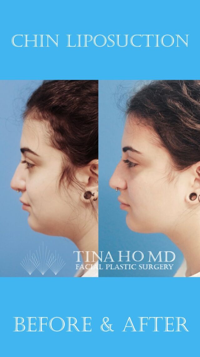 Chin Liposuction: Before and After
Thuy-Van Tina Ho, MD

This beautiful patient in her early 20s came to me for surgical consultation, bothered by the fullness and lack of contour under her chin. We pursued chin liposuction under local anesthesia to sharpen her jawline and neck contour. We are so thrilled with her beautiful, natural results. 

Empowering patients with beautiful, natural results.
Call or visit my website to schedule your jawline contouring consultation.

Thuy-Van Tina Ho, MD
Philadelphia’s Female Facial Plastic Surgeon
Double Board-Certified
Facial & Jawline Contouring Expert
www.drtinaho.com | 610.688.3363
Wayne @phillyfacialplastics 
Philadelphia @centercityderm 

#philadelphiaplasticsurgery #philadelphia #facialplasticsurgeon #facialplasticsurgery #femaleplasticsurgeon #drtinaho #femalesurgeon #womenempoweringwomen #phillybotox #phillybeauty #bestofphilly #mainlinepa #mainlinemoms #waynepa #phillyfacialplastics

#phillystyle #transformationthursday #beforeandafter #instabeauty #jawlinecontouring #facialcontouring #jawlinegoals #snatchedjawline #chinlipo #nonsurgicalfacelift #chinliposuction #kybella #mininecklift #facialrejuvenation #necklift