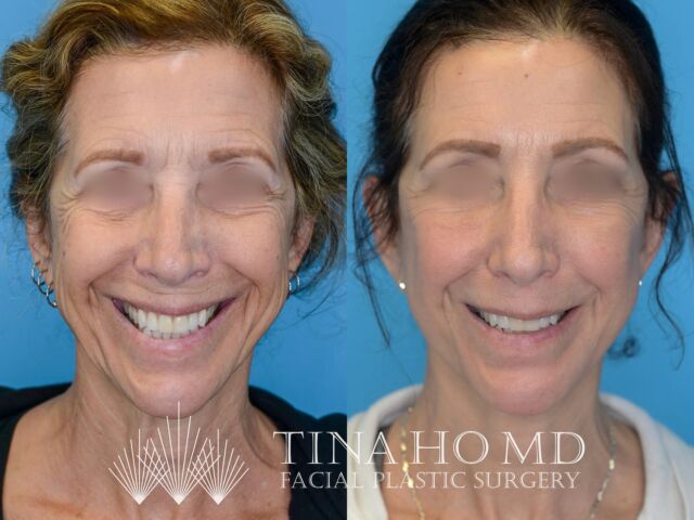 Brow Lift, Eyelid Surgery, Facelift and Neck Lift: Before and After
Thuy-Van Tina Ho, MD

This beautiful patient in her 60s came to me for surgical consultation with global facial aging concerns including heavy brows, lower eyelid bags, facial volume loss jowling, and neck laxity. We pursued deep plane facelift, deep neck lift, brow lift, lower blepharoplasty, facial fat transfer, and CO2 laser resurfacing to rejuvenate her eyes and restore more youthful contour to her face, jawline, and neck. We are so thrilled with her beautiful, natural results. 

Empowering patients with beautiful, natural results.
Call or visit my website to schedule your facial rejuvenation consultation.

Thuy-Van Tina Ho, MD
Philadelphia’s Female Facial Plastic Surgeon
Double Board-Certified
Facial & Jawline Contouring Expert
www.drtinaho.com | 610.688.3363
Wayne @phillyfacialplastics 
Philadelphia @centercityderm 

#philadelphiaplasticsurgery #philadelphia #facialplasticsurgeon #facialplasticsurgery #femaleplasticsurgeon #drtinaho #femalesurgeon #womenempoweringwomen #phillybotox #phillybeauty #bestofphilly #mainlinepa #mainlinemoms #waynepa #phillyfacialplastics

#phillystyle #transformationthursday #beforeandafter #instabeauty #jawlinecontouring #facialcontouring #jawlinegoals #snatchedjawline #facelift #blepharoplasty #deepplanefacelift #faceliftbeforeandafter #browlift #eyelidlift #facialrejuvenation